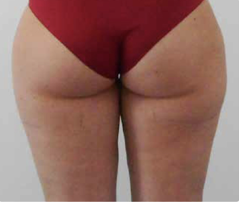Cellulite — dopo il trattamento